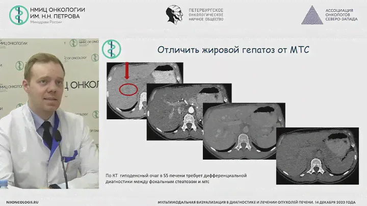 МРТ – золотой стандарт в дифференциальной диагностике опухолей печени?